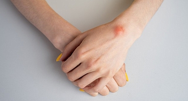Ganglion kistine dikkat