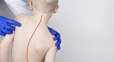 Skolyoz Tedavisinde Doğru Sanılan 7 Yanlışa Dikkat!