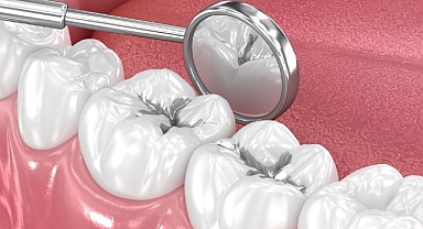 Amalgam Dolgular Değiştirilmeli mi?