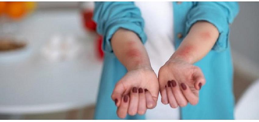 Ütopik Değil Ürtiker! - Prof. Dr. Ahmet Akçay